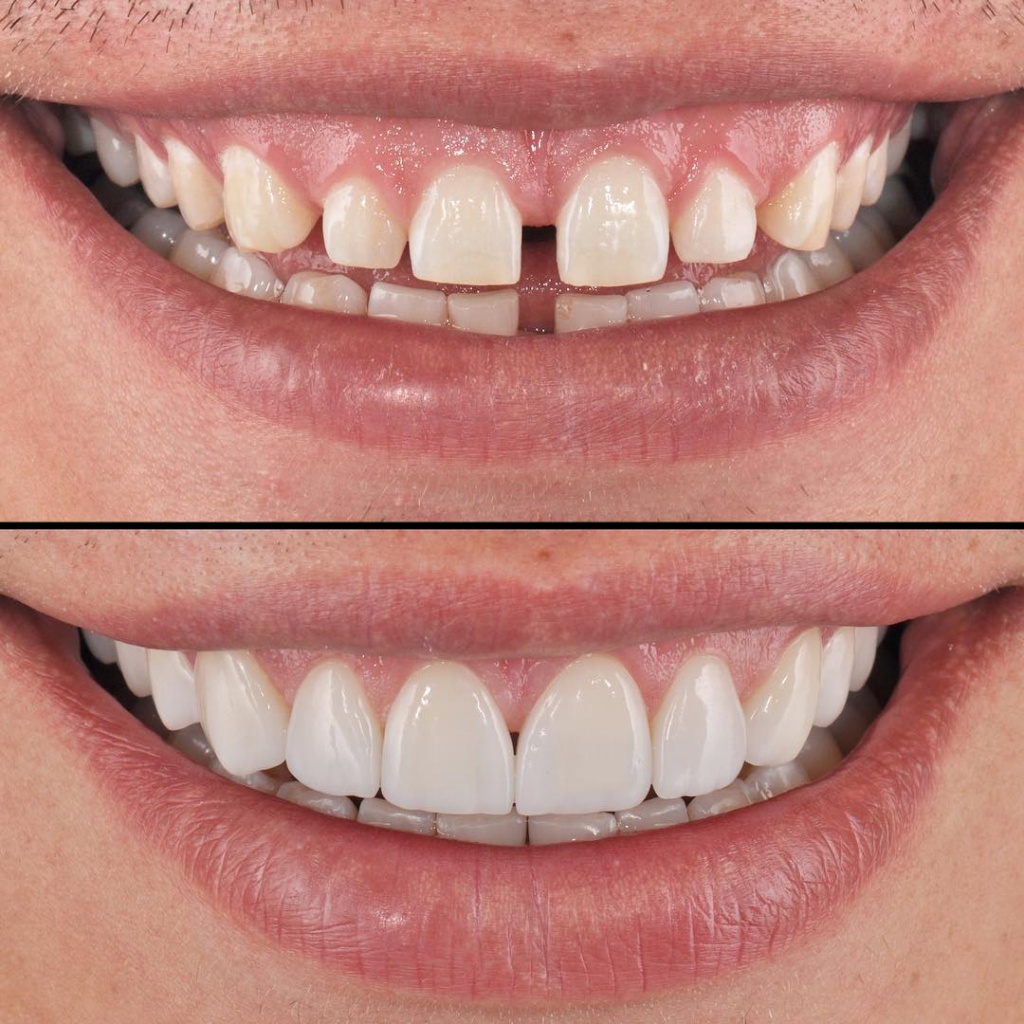 veneers-photo-4.jpg