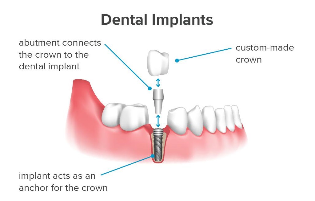 an-infographic-showing-how-dental-implants-work.jpg
