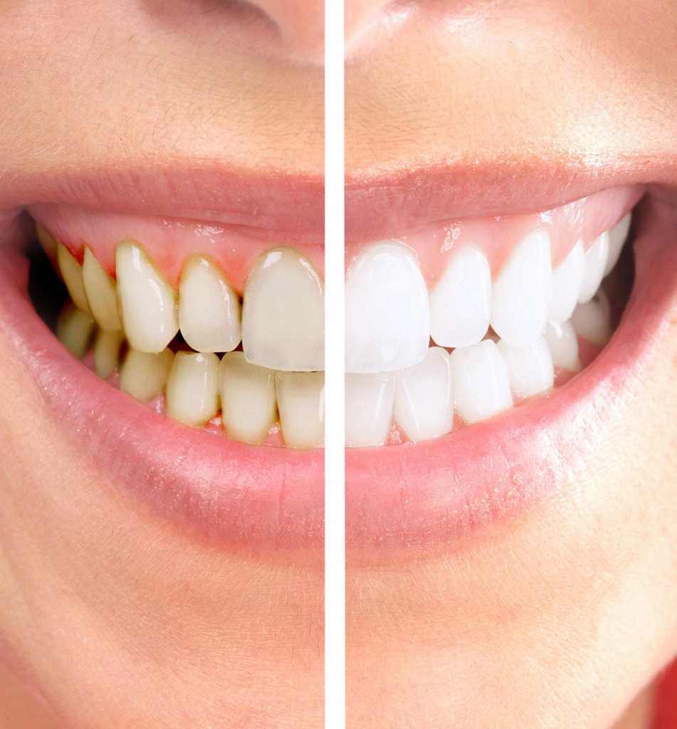 гигиеническая чистка зубов (2).jpg