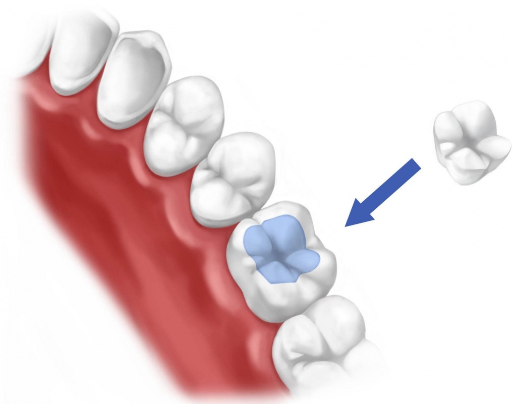 Вкладки на зуб (протезирование и микропротезирование зубов)