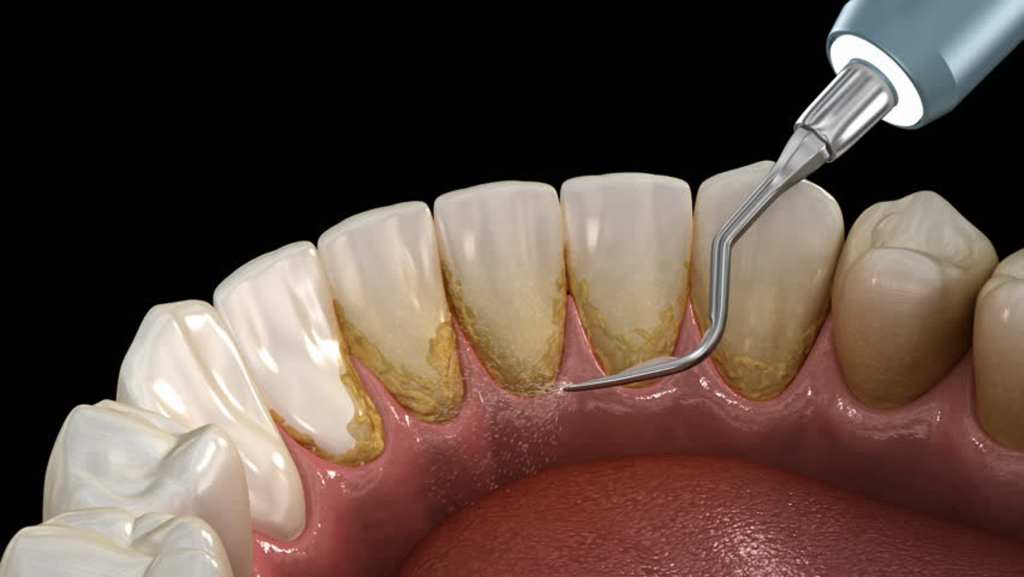 Удаление зубного камня стоматологом